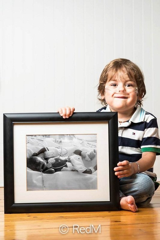 Сквозь годы: трогательные фото детей, родившихся недоношенными: [i]Томас, родился в 23 недели[/i]