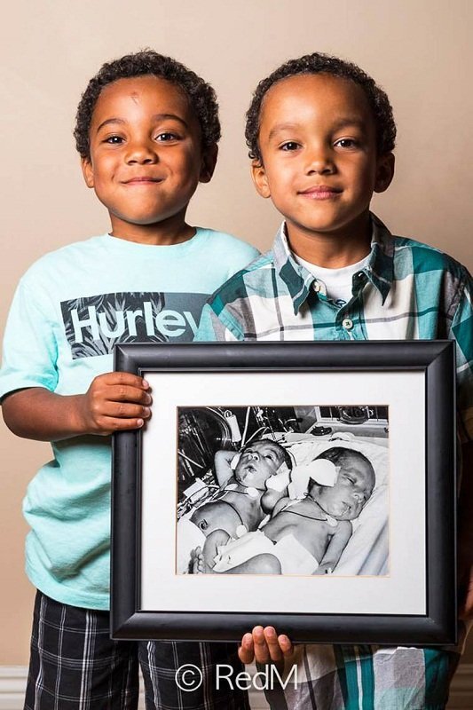 Сквозь годы: трогательные фото детей, родившихся недоношенными: [i]Ной и Натан, родились на 32 неделе[/i]    Показывая нам, какими были эти дети в миг своего рождения,