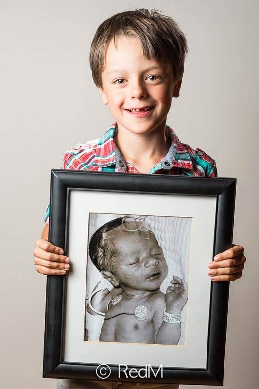 Сквозь годы: трогательные фото детей, родившихся недоношенными: [i]Леонард, родился в 35 недель[/i]