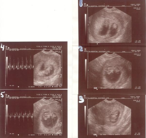Фото узи 3 недели беременности двойняшек