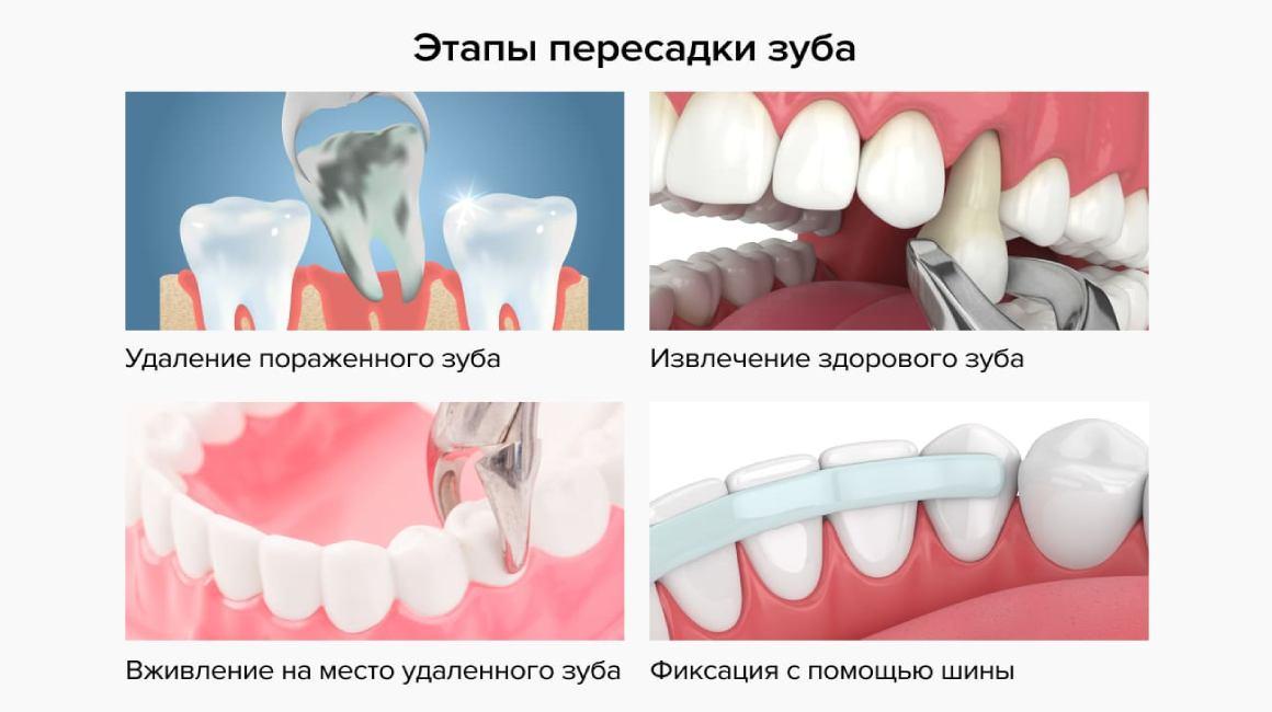 Что такое аутотрансплантация в стоматологии?